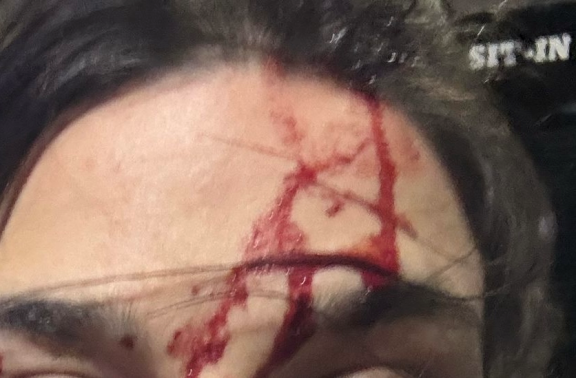 Injury sustained by one of the officers who was kicked multiple times to the head during one of the incidents on 19 February. 